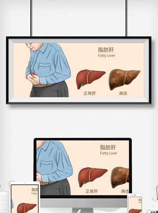 局部肥胖脂肪肝科普医疗插画模板