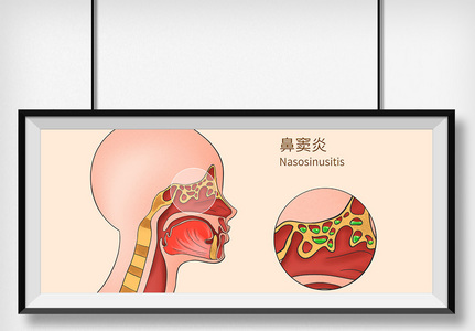 鼻窦炎科普医疗插画图片