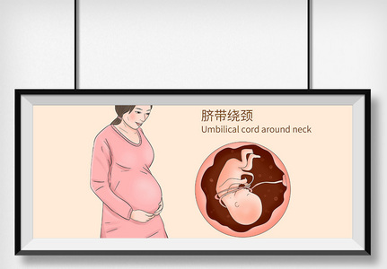 脐带绕颈科普医疗插画图片