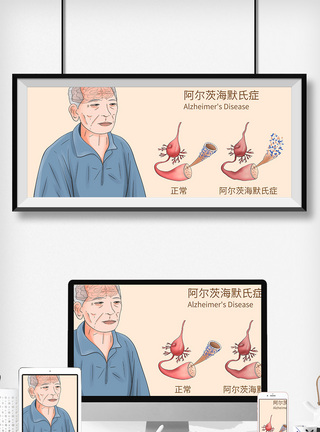 阿尔茨海默氏症科普医疗插画图片