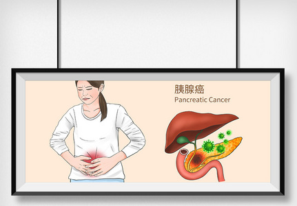 胰腺癌科普医疗插画图片