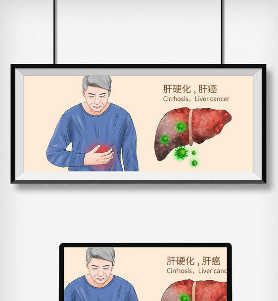 肝硬化肝癌科普医疗插画图片