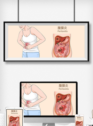 腹膜炎科普医疗插画图片