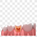牙齿疾病图片