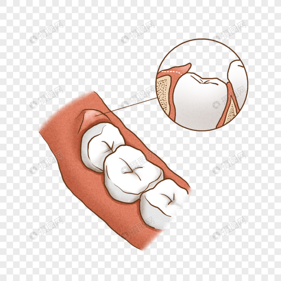 智齿冠周炎图片
