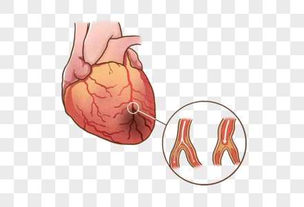 冠心病冠心病插图高清图片