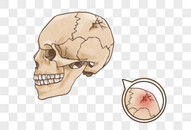 颅骨骨裂图片