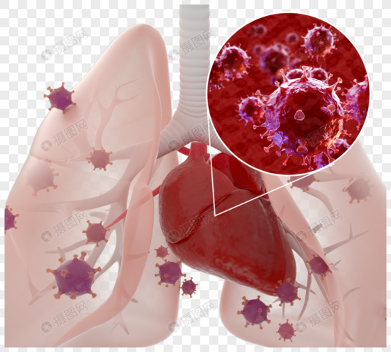 新冠状病毒性肺炎图片