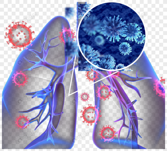 新冠状病毒性肺炎图片