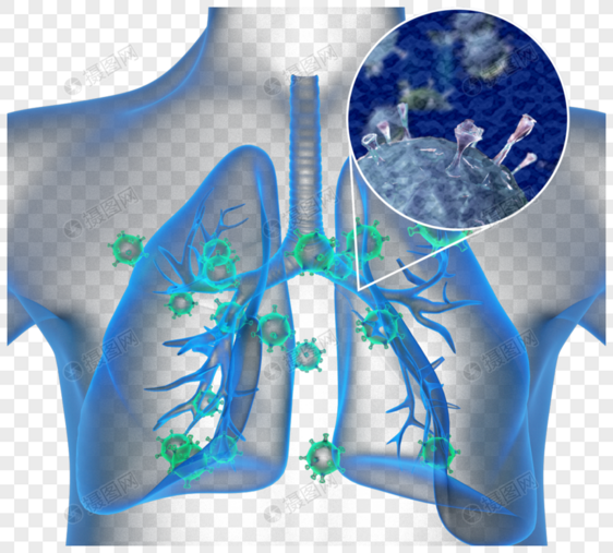 新冠状病毒性肺炎图片