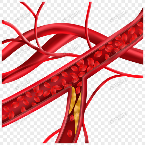 人体血管胆固醇堵塞动脉医学插图图片