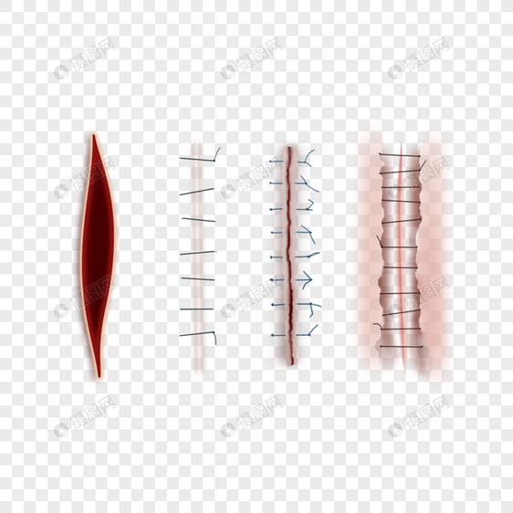 手术医疗缝合伤口图片