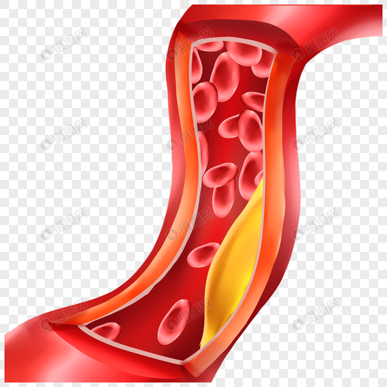 人体血管医学动脉硬化插图图片