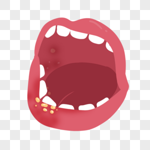 口腔溃疡嘴巴图图片