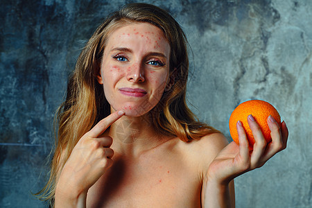 轻女人橘子过敏脸上很多痤疮,她很开心图片