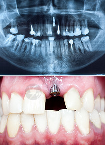 口腔内种植牙的观镜头及其全景牙科背景图片