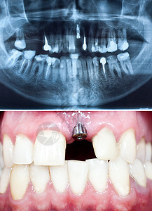 口腔内种植牙的观镜头及其全景牙科背景图片