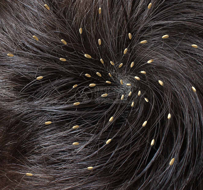 头虱医学与个人的头部 寄生的nits卵孵化头皮附近虱子诊断预防治疗儿童成人的象征高清图片下载 正版图片 摄图网