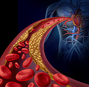 血管的堵塞动脉动脉粥样硬化疾病的医学与个三维人动脉与血细胞,被斑块建立胆固醇动脉硬化血管疾病的象征而阻断背景