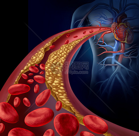 堵塞动脉动脉粥样硬化疾病的医学与个三维人动脉与血细胞,被斑块建立胆固醇动脉硬化血管疾病的象征而阻断图片