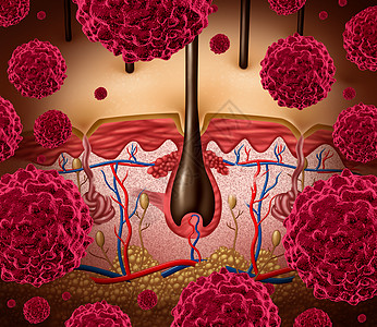 皮肤癌黑色素瘤医学种被恶癌细胞攻击的人表皮解剖背景图片