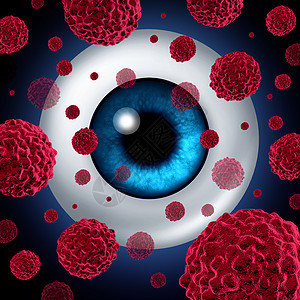 眼癌眼内癌象征着人类眼球,癌细胞健康保健医疗标志传播,导致眼部肿瘤风险,导致视力丧失失明图片