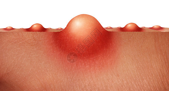 痤疮皮肤保健粉刺疮人类皮肤上医学解剖标志的皮肤表皮紊乱的白色背景图片