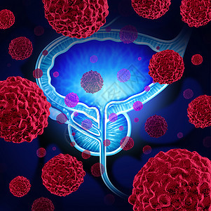前列腺癌危险医学男体内的癌细胞攻击生殖系统,人类恶肿瘤生长诊断治疗风险的象征图片