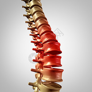 脊柱疼痛下背部疾病人类背痛与三维脊柱身体骨架脊椎脊椎发光红色突出医疗保健的关节疼痛图片