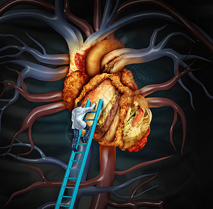 高胆固醇治疗医疗治疗,医生梯子上清洁个问题的心脏由油腻的快餐外科医生清除脂肪堆积堵塞的人体器官,动脉粥样硬化疾图片