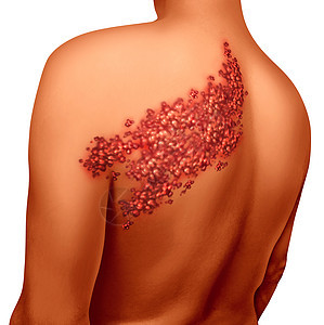 背部带状疱疹疾病感染的荨麻疹疮图片
