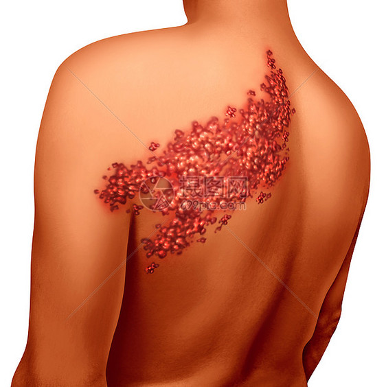 背部带状疱疹疾病感染的荨麻疹疮图片