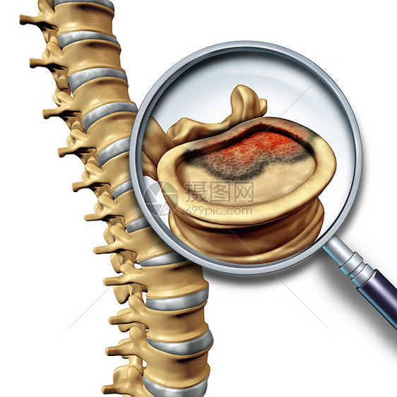 脊柱癌症脊柱肿瘤疾病的医学,如骨骼椎体与放大镜,接近个边缘与癌症生长图片