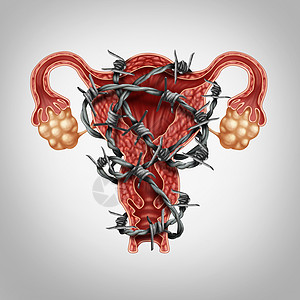 子宫腹痛的医学与痛苦的铁丝网包裹解剖上,子宫内膜异位症的问题,人类女生殖符号生育生殖系统疾病疾病的象征图片