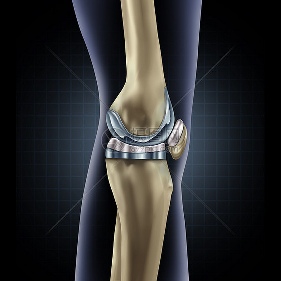 膝关节置换植入医学种人腿解剖后,假体手术肌肉骨骼疾病治疗符号的骨科三维插图元素图片