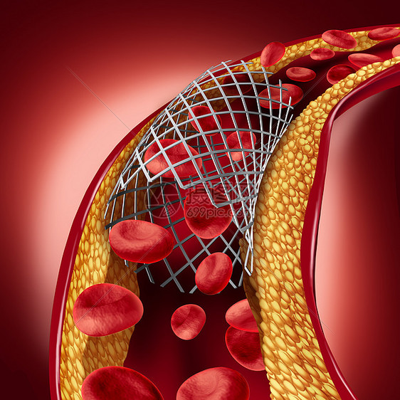支架植入的种心脏病治疗的象征,动脉中血管成形术的过程,胆固醇斑块堵塞被打开,以增加三维图示图片