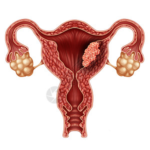 子宫内膜癌子宫子宫癌的医学,女体内攻击生殖系统的癌细胞,宫颈肿瘤生长治疗诊断症状的标志,三维插图元素图片