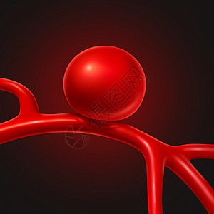 动脉瘤的医学种医学符号,用于症状诊断血管膨胀成气球的形状,破裂的风险三维图示图片