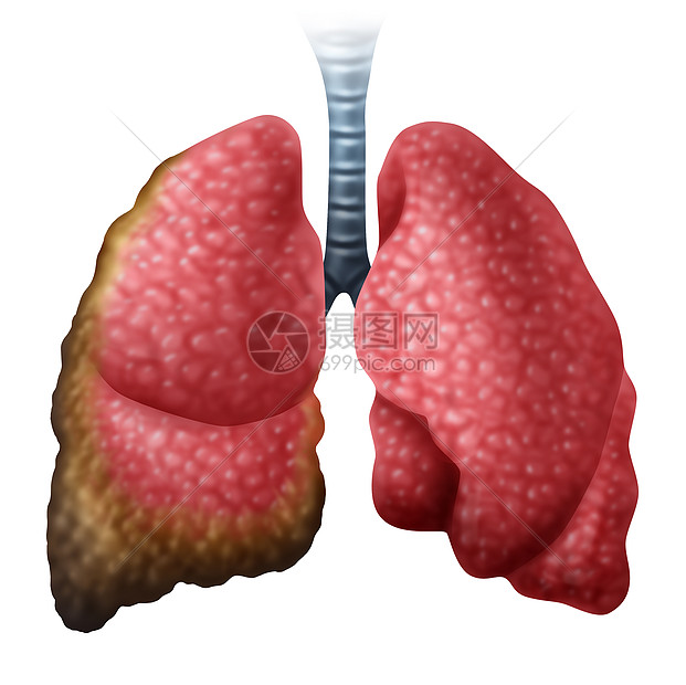 间皮瘤癌症疾病人类肺部生长恶癌细胞种医疗疾病的符号石棉暴露三维插图风格图片