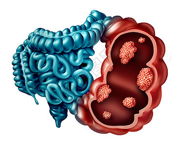 结肠癌种人类肠道疾病,以人体解剖学中的微小恶肿瘤为例图片