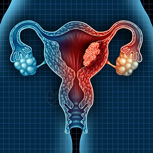 子宫癌子宫内膜恶肿瘤种子宫医学,种危险的生长细胞女体内攻击生殖系统,宫颈疾病治疗诊断症状的标志,具背景图片
