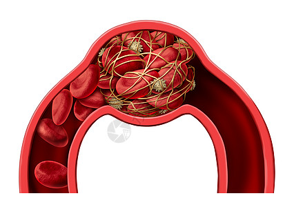 碳纤血栓医学三维插图插画