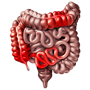 克罗娜疾病克罗恩病医学人类肠道炎症症状引梗阻的三维图示背景图片