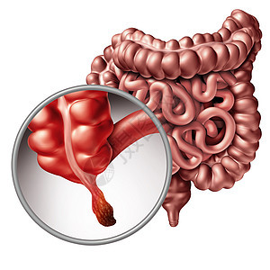 阑尾炎阑尾炎疾病的人体肠道解剖的个特写,三维插图图片