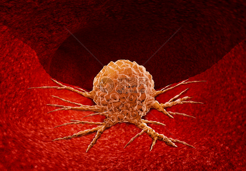 癌症解剖种生长的肿瘤细胞恶疾病人体内器官上的生长,三维插图癌症解剖图片