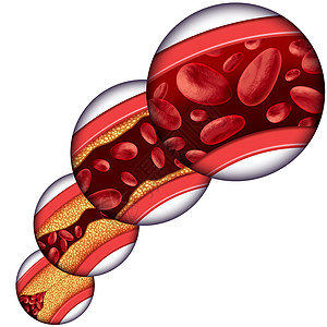 冠状动脉胆固醇治疗医学种静脉,堵塞的动脉动脉粥样硬化中逐渐清除斑块,并附减少胆固醇积累的三维人体解剖图图片