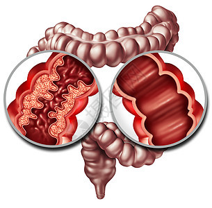 克罗恩综合征疾病克罗恩病健康结肠种医学,接近人类肠道,炎症症状引阻塞,三维插图图片