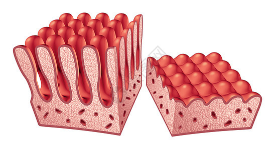 腹腔腹腔疾病解剖医学与正常绒毛受损的小肠衬里自身免疫疾病的消化系统三维图示背景图片