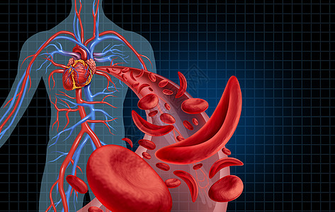 镰状细胞心血管血液循环贫血种疾病与正常异常血红蛋白人动脉解剖医学插图与三维插图元素图片
