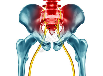 坐骨神经痛症状诊断医学,种疾病,引身体问题的三维插图元素白色背景背景图片